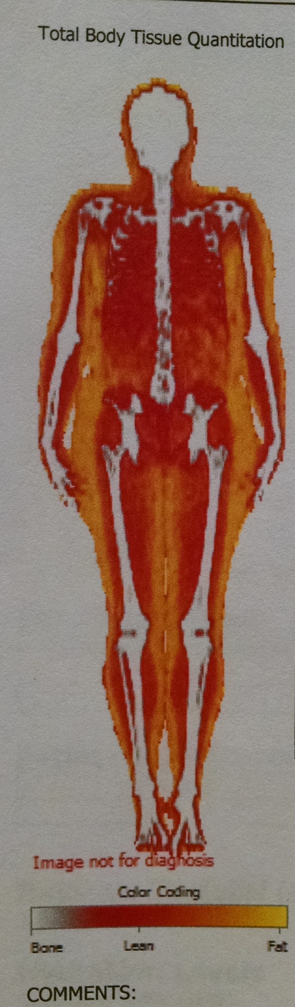LI Dxa scan
